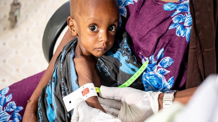 Global hunger crisis pushes one child per minute into severe malnutrition: UNICEF Global hunger crisis pushes one child per minute into severe malnutrition: UNICEF