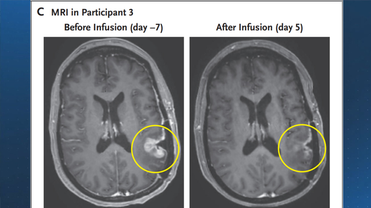 New strategy to fight aggressive brain tumor shows promise New strategy to fight aggressive brain tumor shows promise